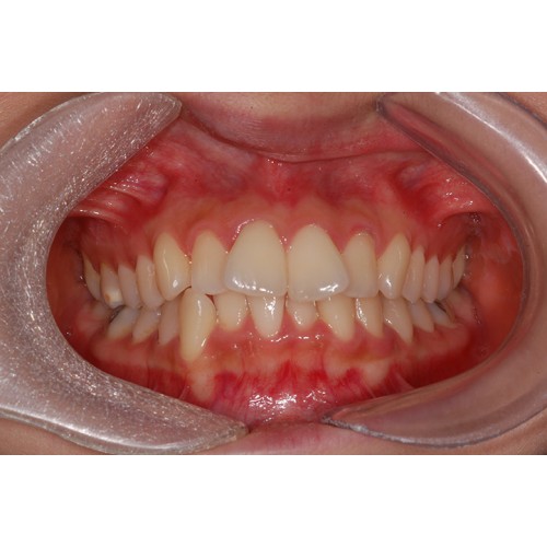 CLI crowding 돌출 …